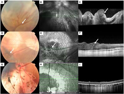 Evaluation of a steroid delivery system to mitigate the severity of proliferative vitreoretinopathy in a minipig model